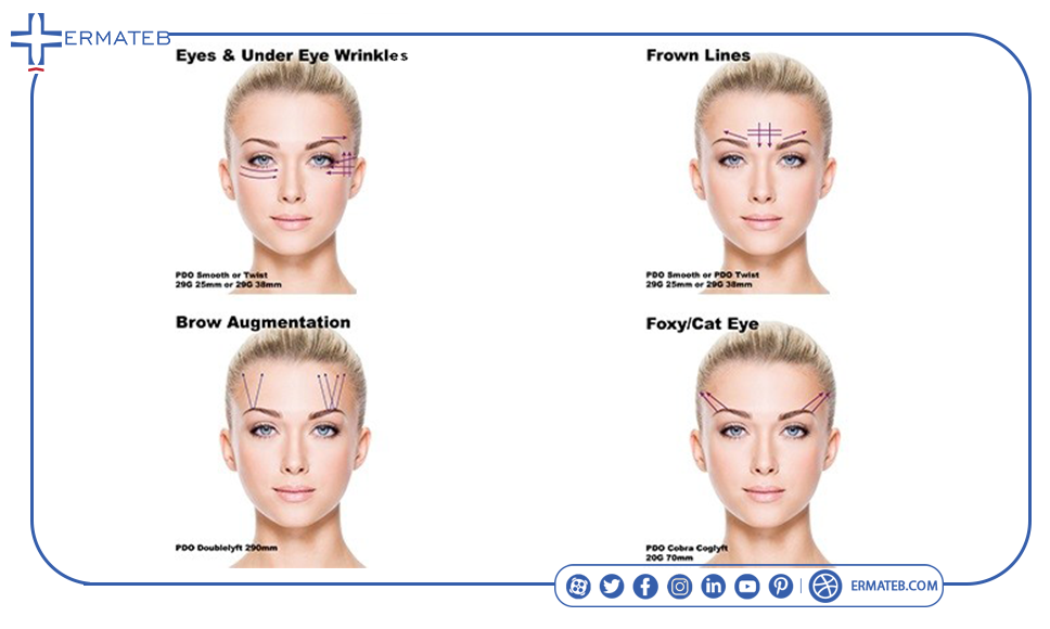 types of eye lift